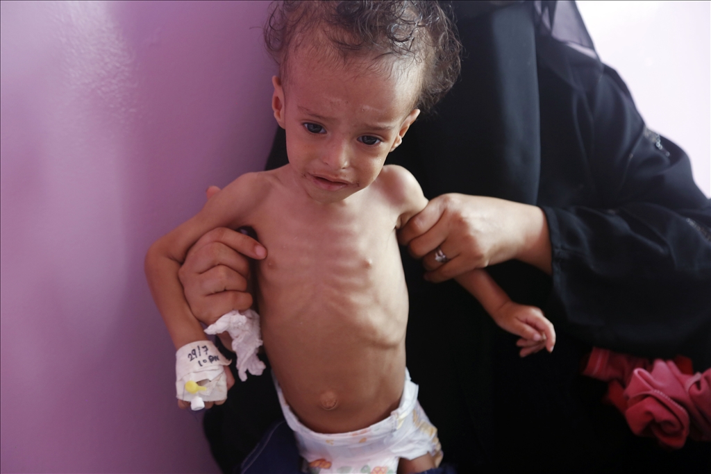 Yemeni children suffering from malnutrition are treated at Sabeen Hospital  