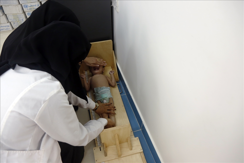Yemeni children suffering from malnutrition are treated at Sabeen Hospital  