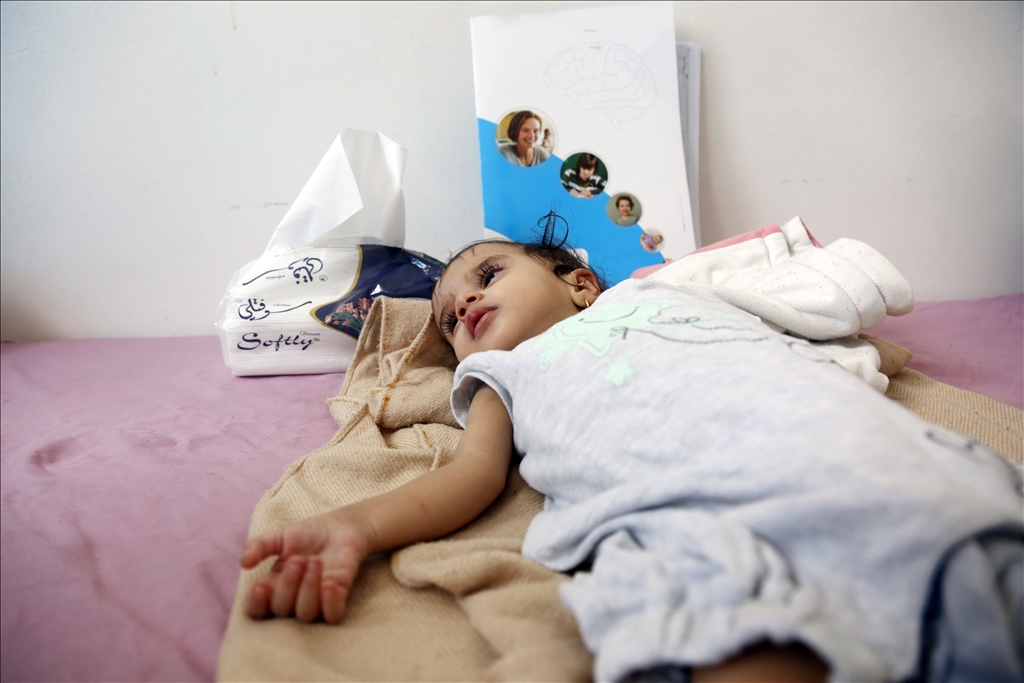 Yemeni children suffering from malnutrition are treated at Sabeen ...