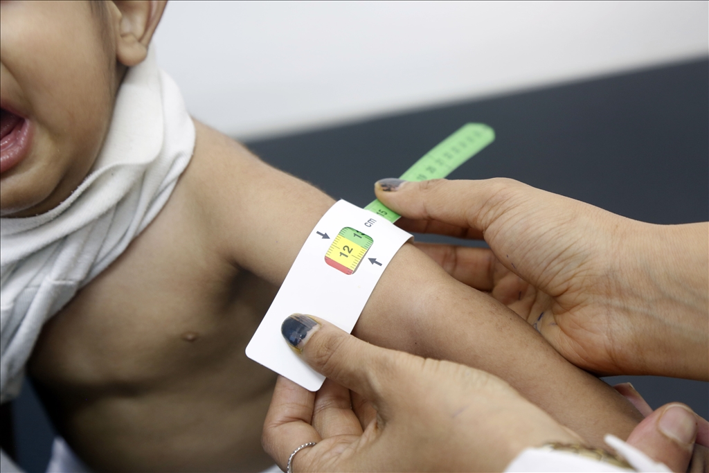 Yemeni children suffering from malnutrition are treated at Sabeen Hospital  