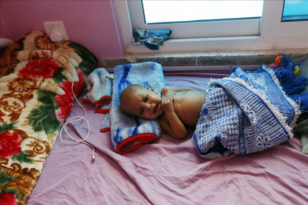 Yemeni children suffering from malnutrition are treated at Sabeen Hospital  