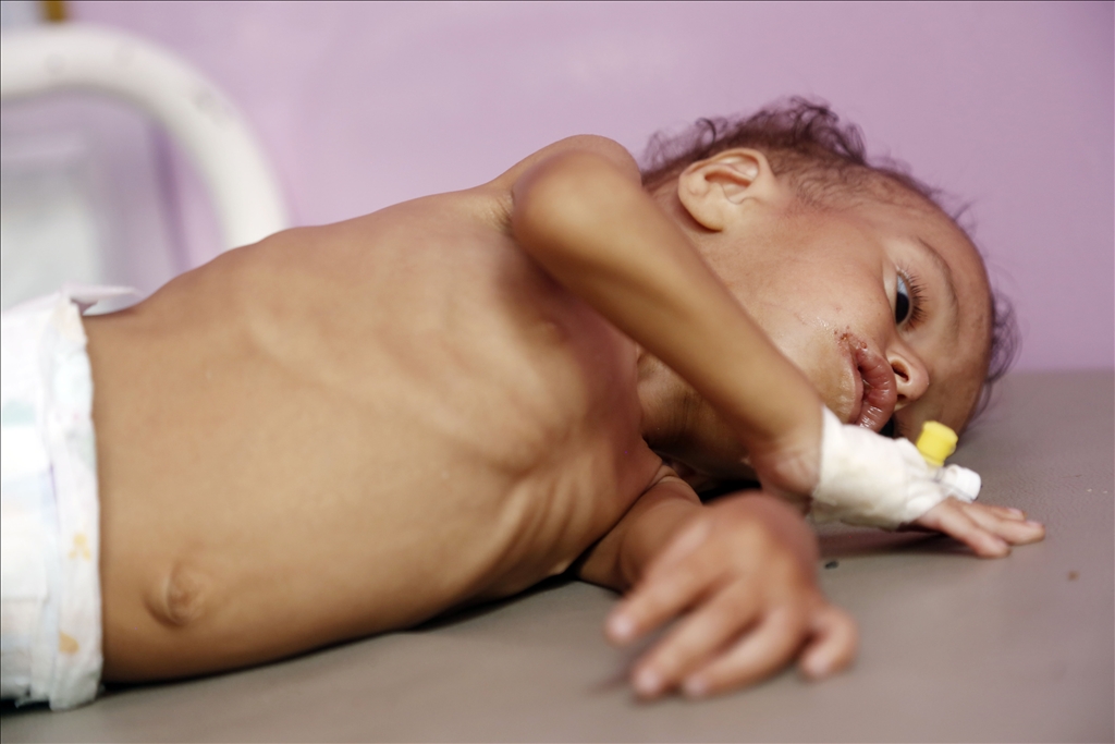 Yemeni children suffering from malnutrition are treated at Sabeen Hospital  