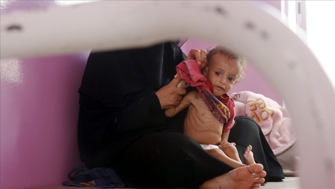 Yemeni children suffering from malnutrition are treated at Sabeen Hospital  