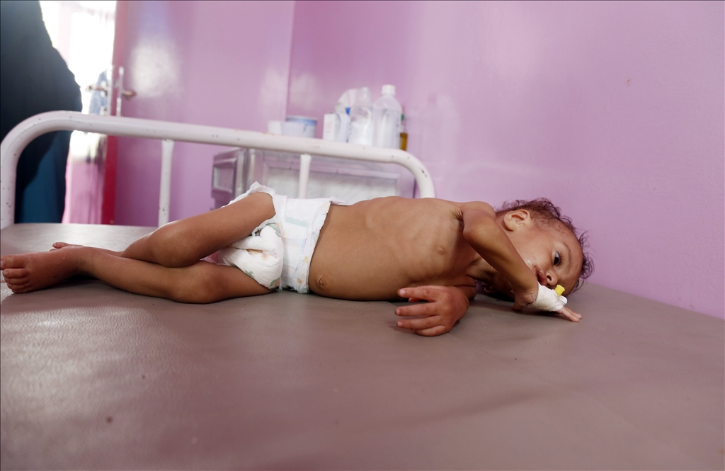 Yemeni children suffering from malnutrition are treated at Sabeen Hospital  
