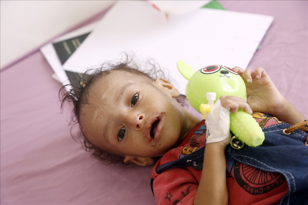 Yemeni children suffering from malnutrition are treated at Sabeen Hospital  