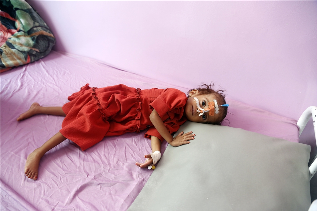 Yemeni children suffering from malnutrition are treated at Sabeen Hospital  