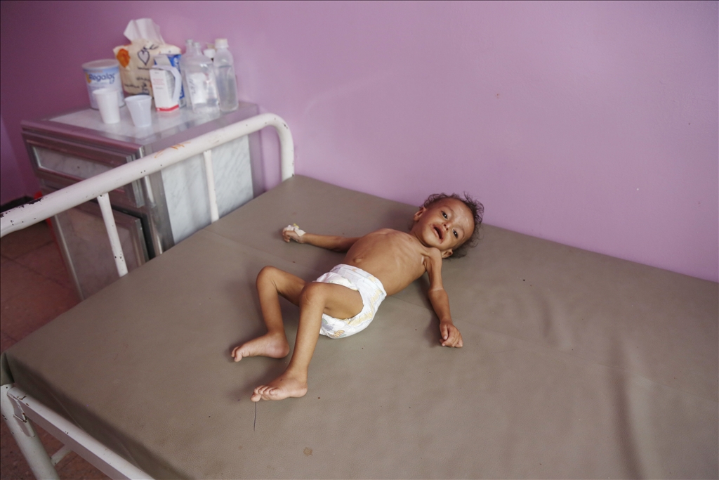 Yemeni children suffering from malnutrition are treated at Sabeen Hospital  