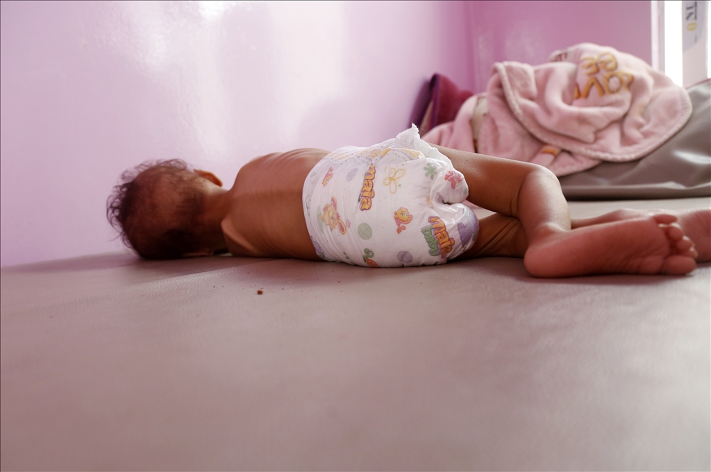 Yemeni children suffering from malnutrition are treated at Sabeen Hospital  