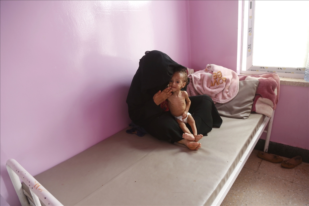 Yemeni children suffering from malnutrition are treated at Sabeen Hospital  