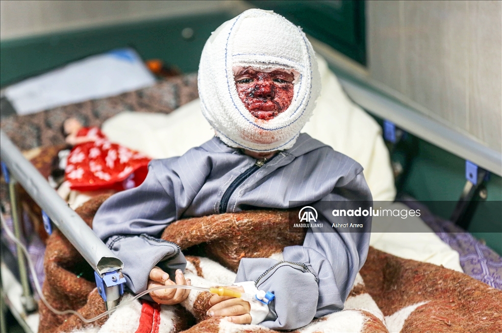 İsrail ordusu, minik bedeninde derin yanıklar açtığı 4 yaşındaki Seca’yı hastanede de rahat bırakmadı
