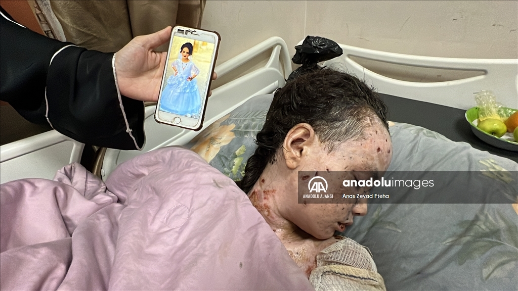 İsrail saldırılarında ağır yaralanan Gazzeli Hanan, yaşam mücadelesi veriyor