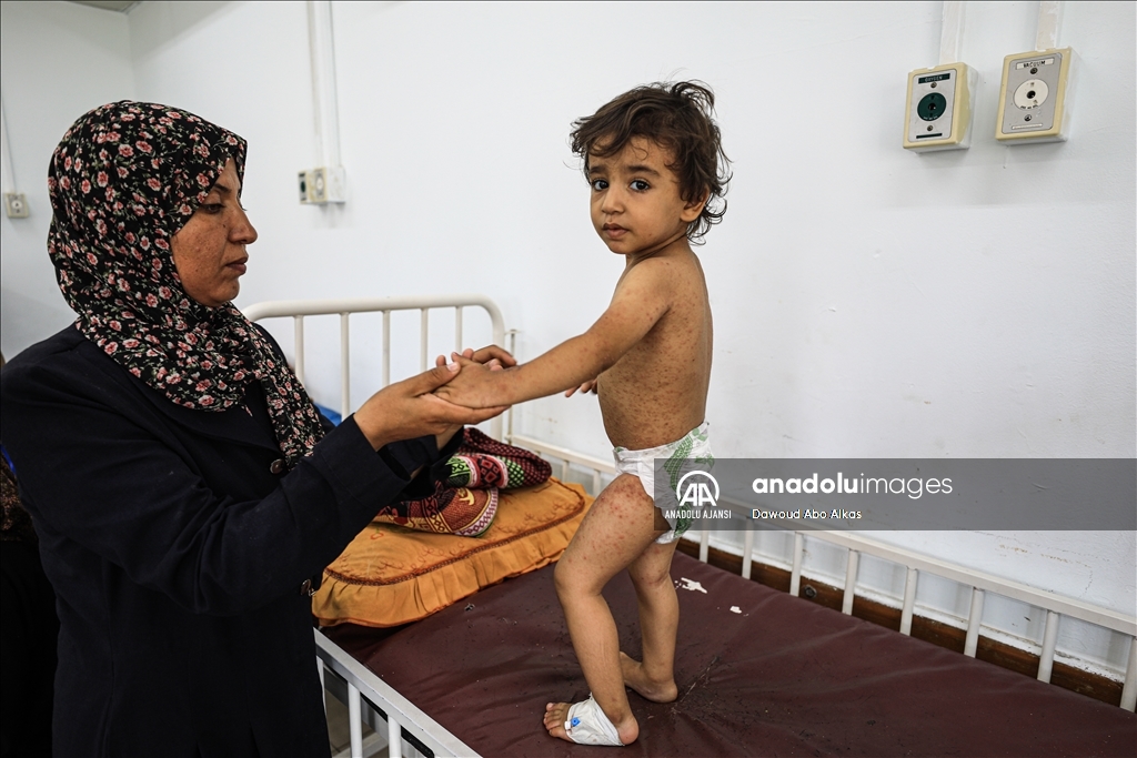 Gazze'deki çocuklarda cilt hastalıkları vakaları yayılıyor