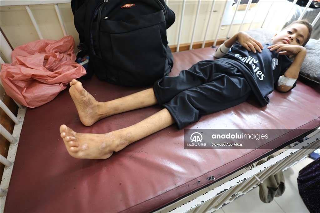 Gazze'deki çocuklarda cilt hastalıkları vakaları yayılıyor