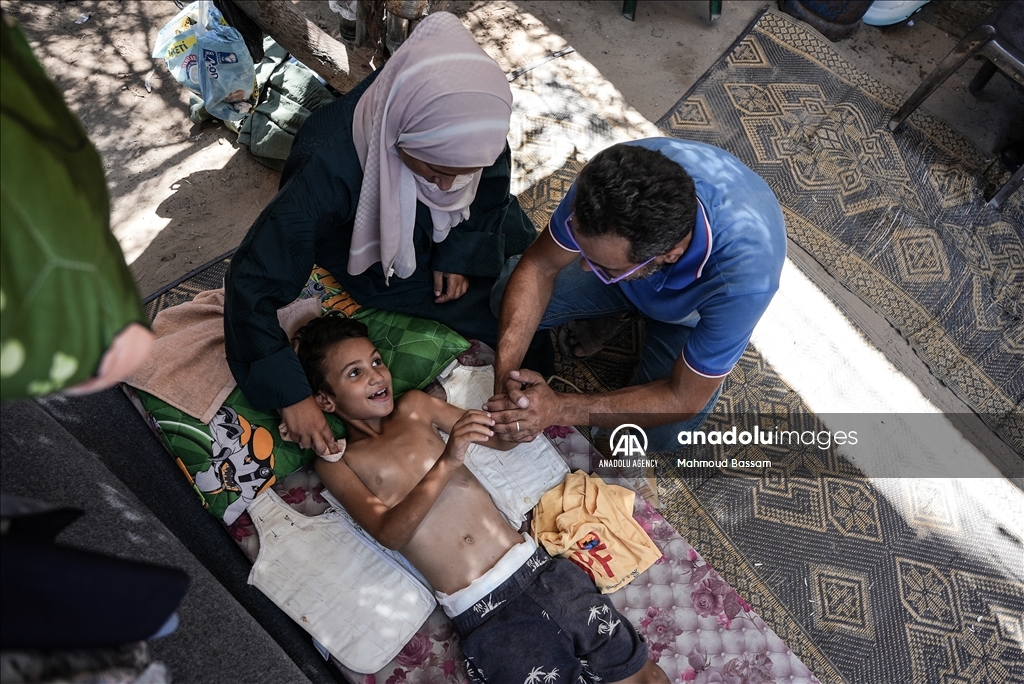 قبل تلقيه لقاح شلل الاطفال.. طفل فلسطيني تعرض لهجوم إسرائيلي افقده الحركة في غزة