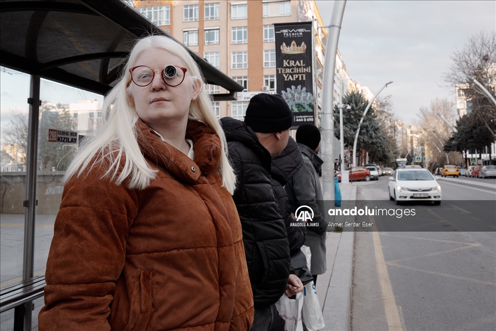 Dünya Nadir Hastalıklar Günü: "Albino olmak"