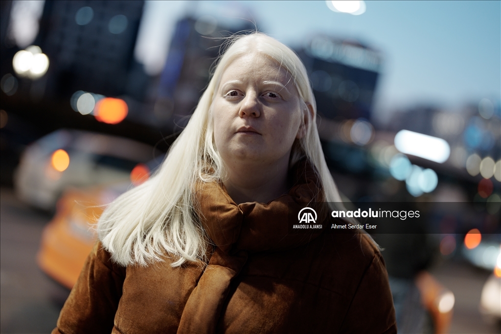 Dünya Nadir Hastalıklar Günü: "Albino olmak"