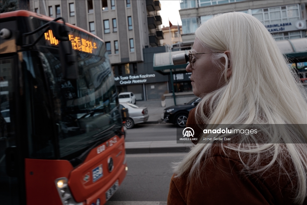 Dünya Nadir Hastalıklar Günü: "Albino olmak"