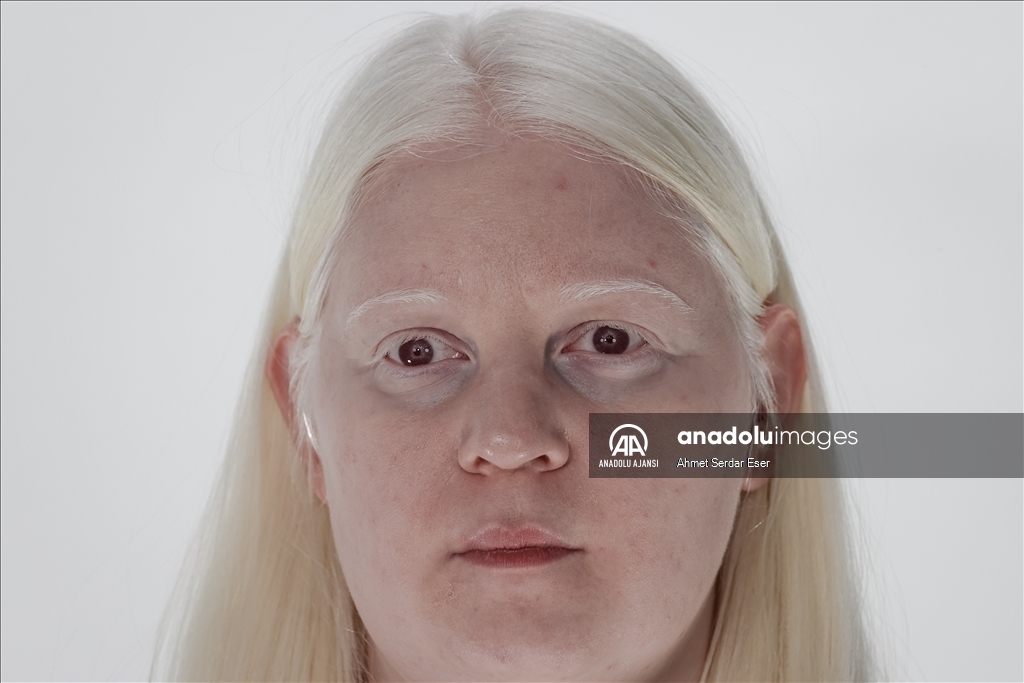 Dünya Nadir Hastalıklar Günü: "Albino olmak"