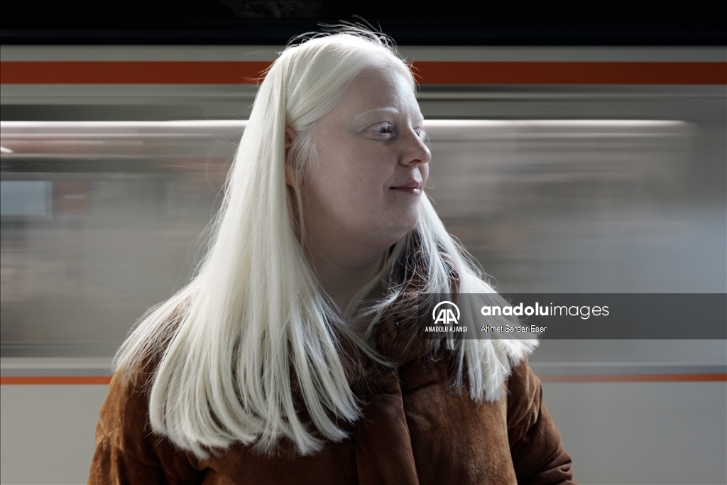 Dünya Nadir Hastalıklar Günü: "Albino olmak"