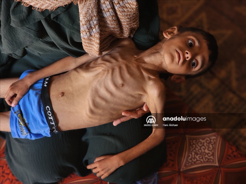 İsrail ablukası nedeniyle Gazze'de çocukların yetersiz beslenme vakaları giderek artıyor