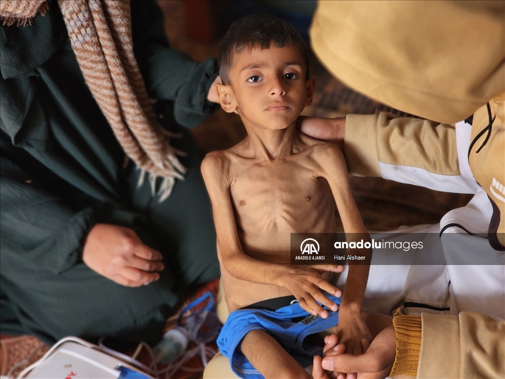 İsrail ablukası nedeniyle Gazze'de çocukların yetersiz beslenme vakaları giderek artıyor