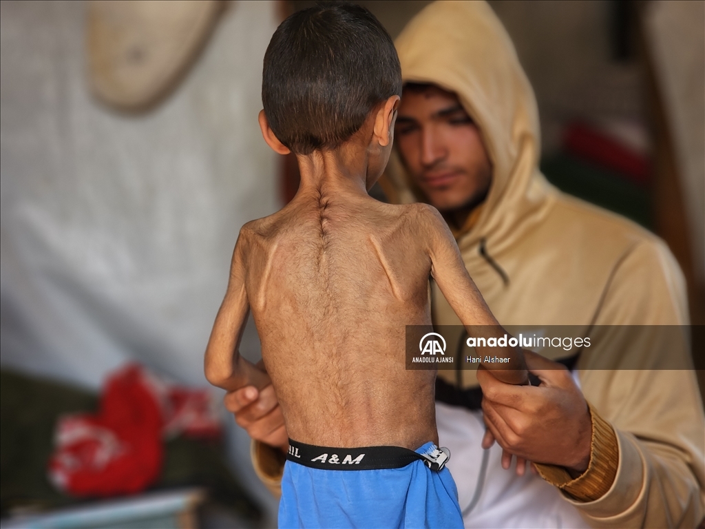 İsrail ablukası nedeniyle Gazze'de çocukların yetersiz beslenme vakaları giderek artıyor