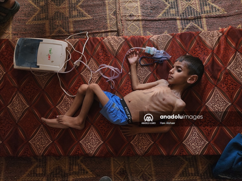 İsrail ablukası nedeniyle Gazze'de çocukların yetersiz beslenme vakaları giderek artıyor