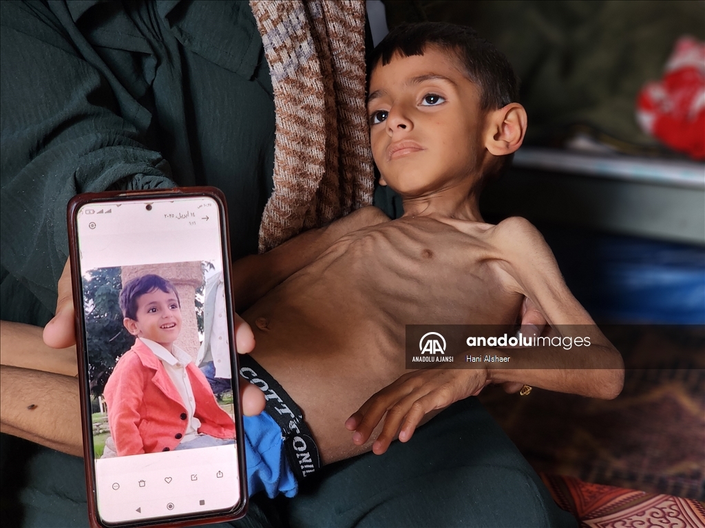 İsrail ablukası nedeniyle Gazze'de çocukların yetersiz beslenme vakaları giderek artıyor