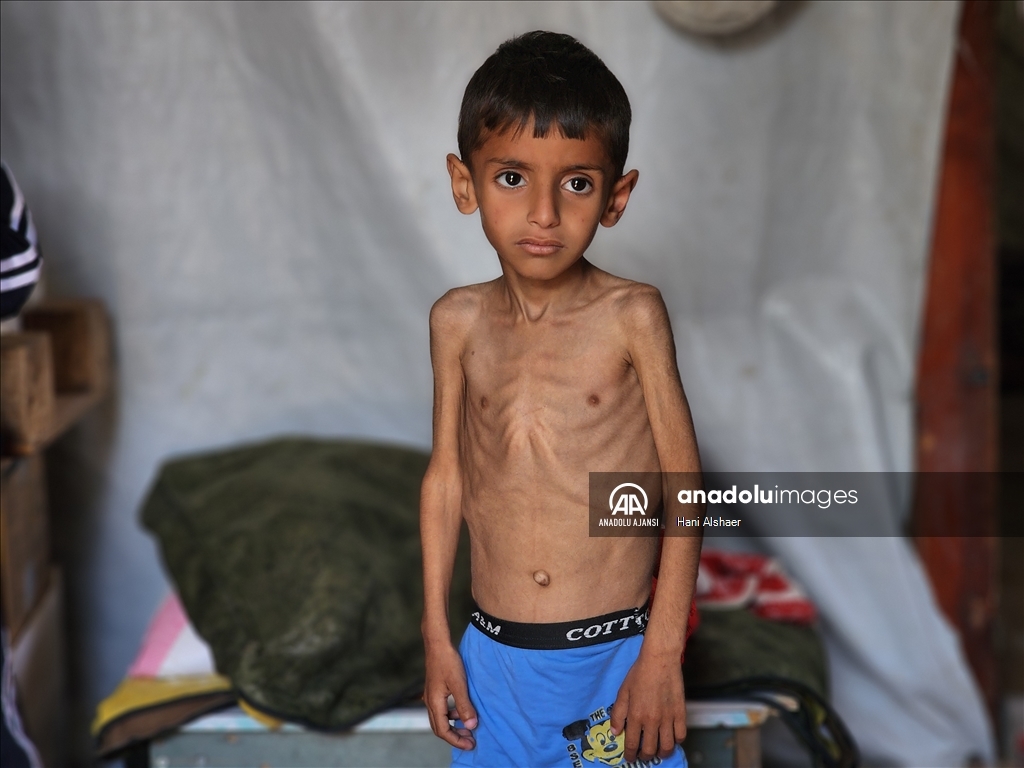 İsrail ablukası nedeniyle Gazze'de çocukların yetersiz beslenme vakaları giderek artıyor