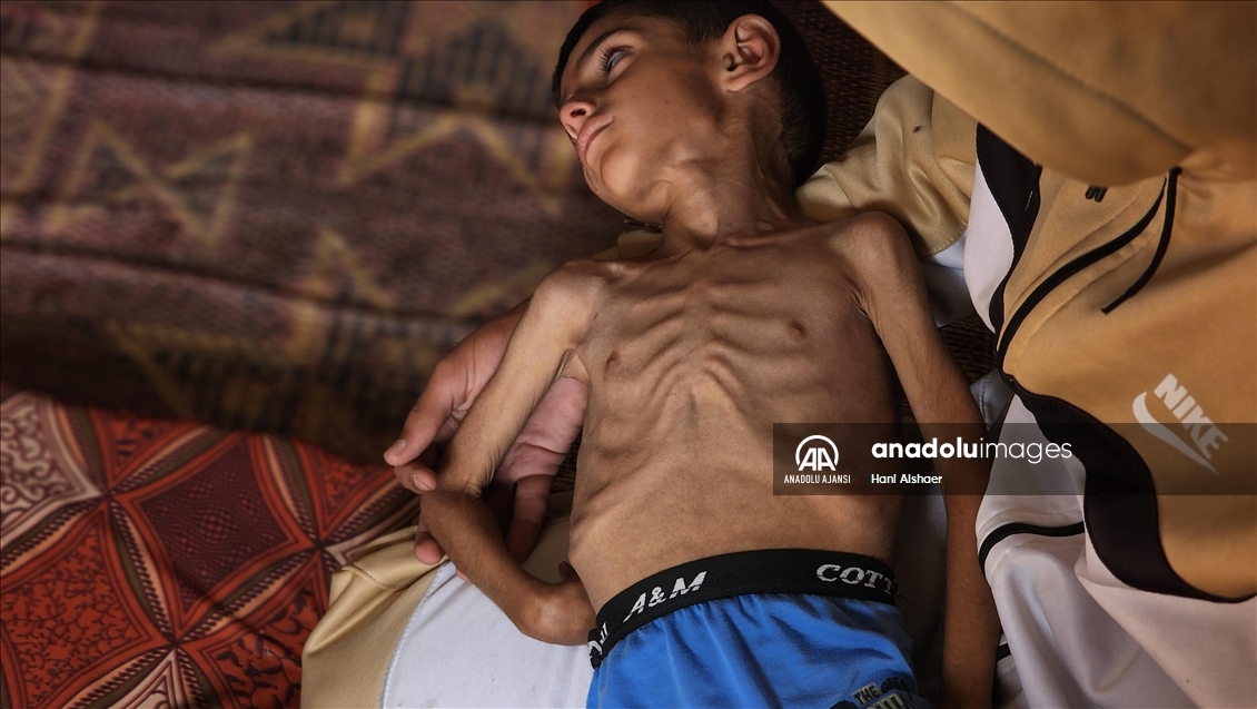 İsrail ablukası nedeniyle Gazze'de çocukların yetersiz beslenme vakaları giderek artıyor