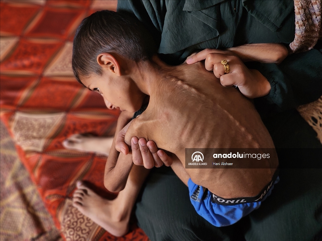 İsrail ablukası nedeniyle Gazze'de çocukların yetersiz beslenme vakaları giderek artıyor