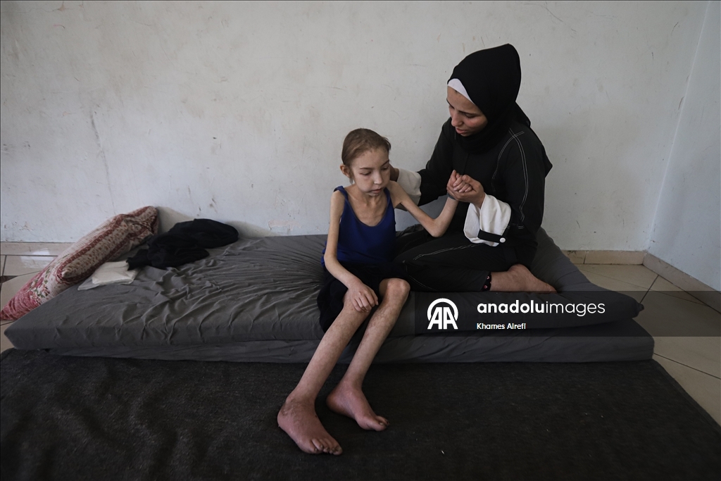 رهف عياد.. طفلة تنهشها الإبادة في غزة وسط عجز طبي وحصار خانق