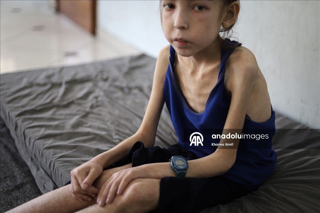 رهف عياد.. طفلة تنهشها الإبادة في غزة وسط عجز طبي وحصار خانق