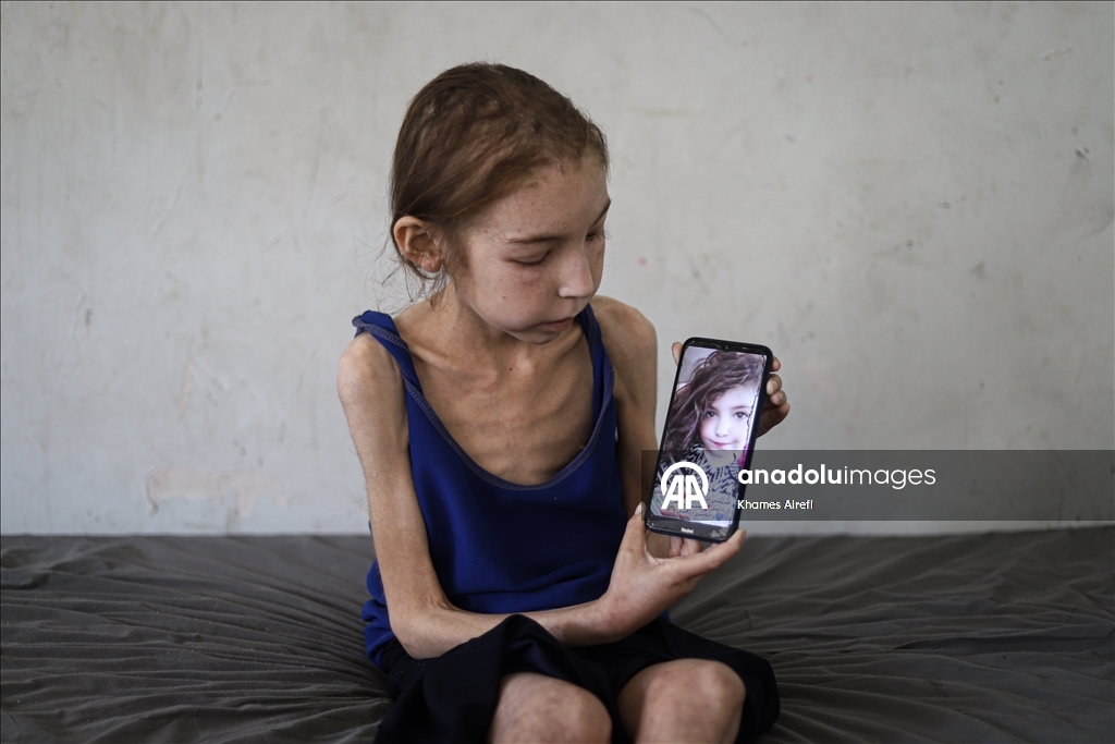 رهف عياد.. طفلة تنهشها الإبادة في غزة وسط عجز طبي وحصار خانق