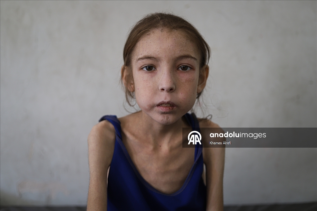 İsrail ablukası nedeniyle Gazze'de beslenme ve ilaç sıkıntısı giderek derinleşiyor