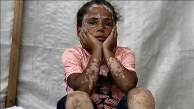 İsrail'in hedef gözetmeyen saldırıları, Gazzeli çocuk Lana’nın vitiligo hastalığına yakalanmasına neden oldu