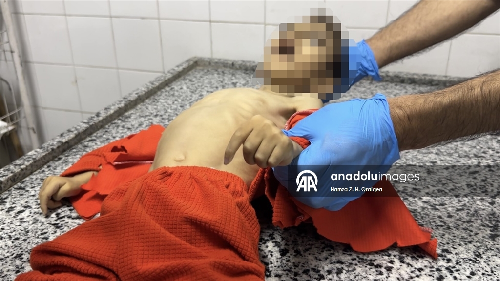 İsrail ablukası altındaki Gazze'de 4 yaşındaki Mustafa şiddetli yetersiz beslenme nedeniyle hayatını kaybetti