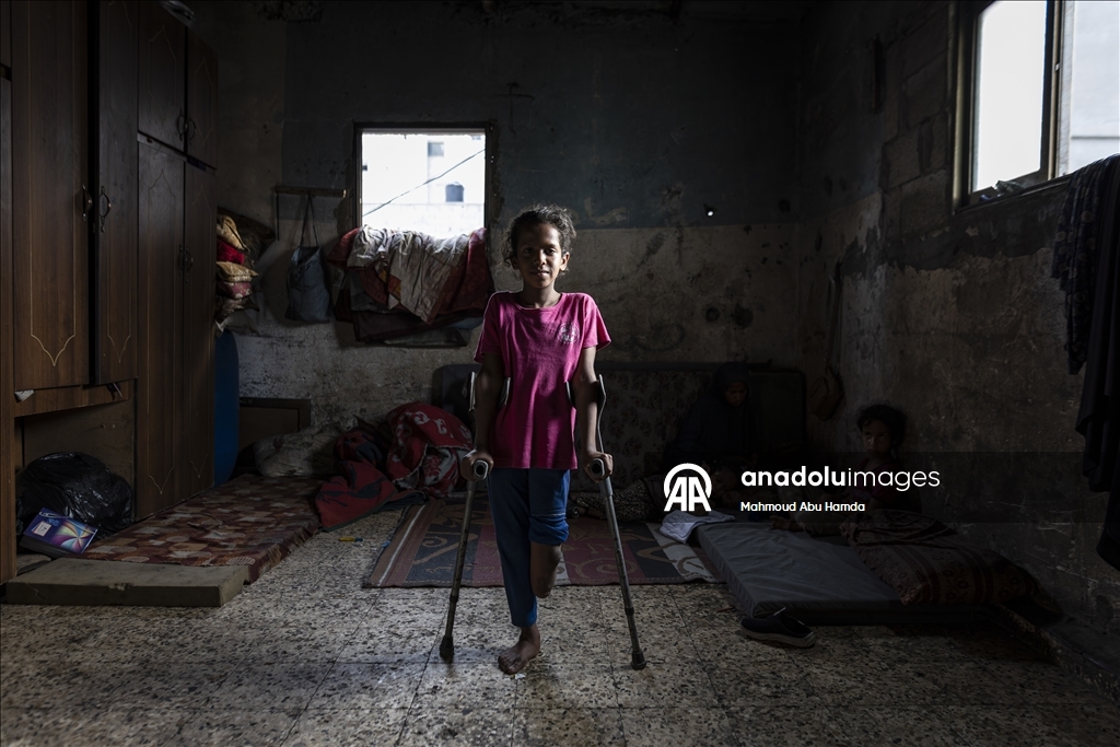 Vajza palestineze që humbi këmbën në sulmin izraelit pret të ketë një këmbë protetike