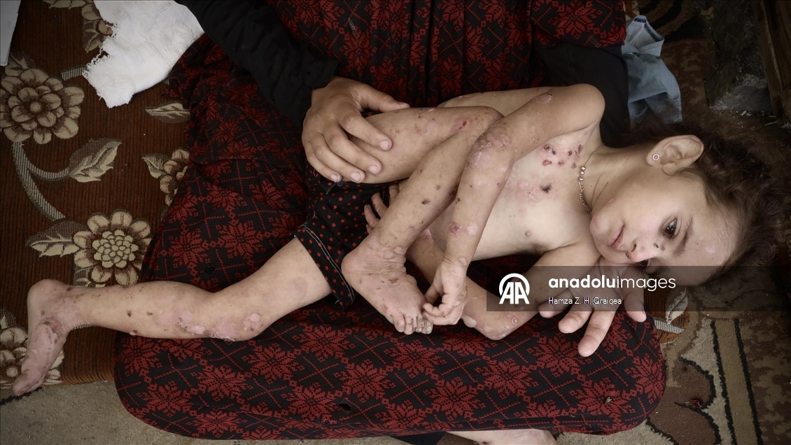 Gazze’de savaşın ortasında hastalıkla mücadele eden küçük Sunduz, yardım bekliyor