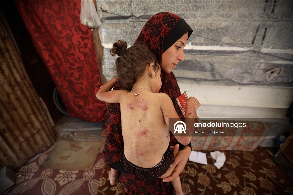 Gazze’de savaşın ortasında hastalıkla mücadele eden küçük Sunduz, yardım bekliyor