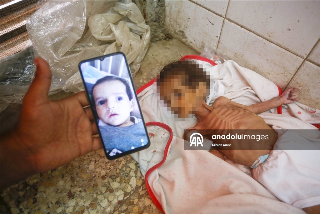 Gazze'de bir çocuk daha yetersiz beslenme nedeniyle yaşamını yitirdi