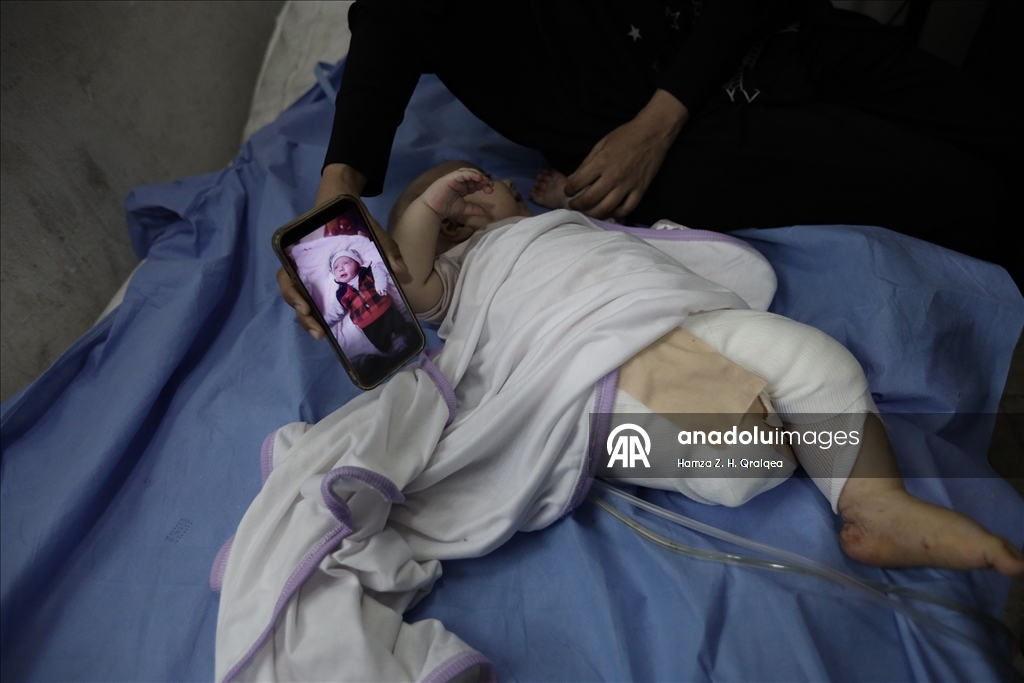 Anne kucağındayken İsrail bombardımanına yakalanan 4 Aylık bebek, yaşamına tek bacakla devam edecek