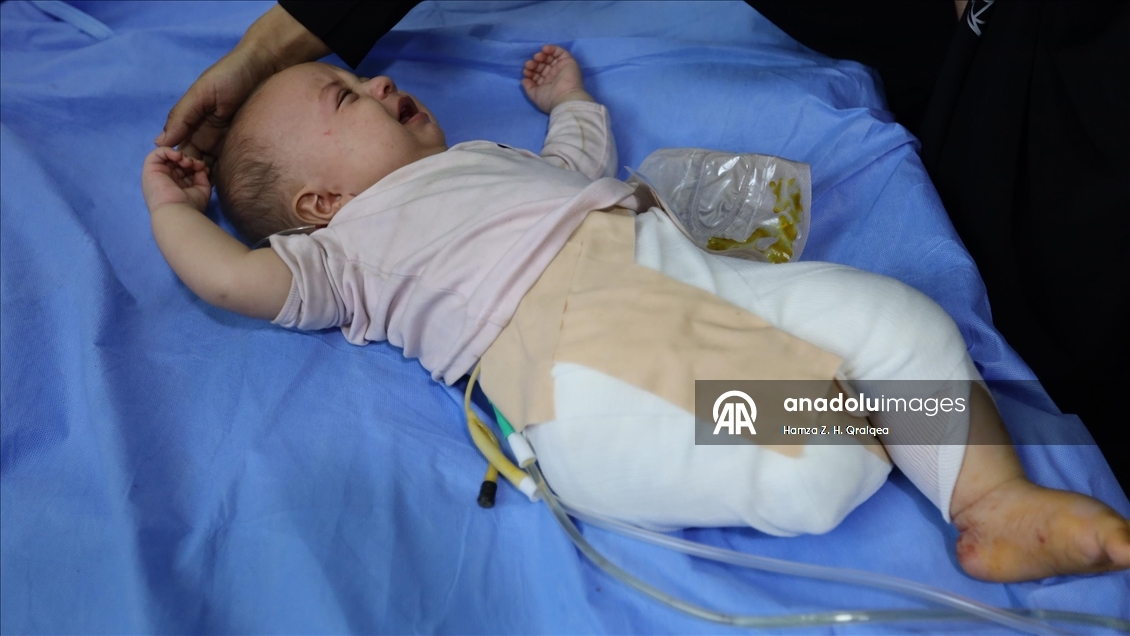 Anne kucağındayken İsrail bombardımanına yakalanan 4 Aylık bebek, yaşamına tek bacakla devam edecek