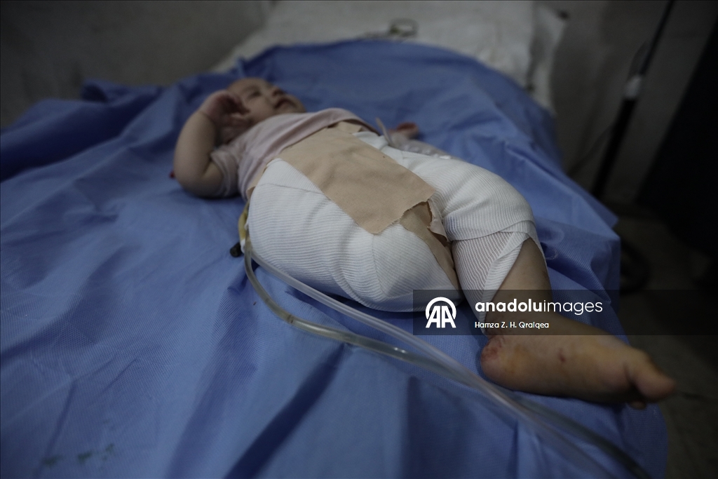 Anne kucağındayken İsrail bombardımanına yakalanan 4 Aylık bebek, yaşamına tek bacakla devam edecek