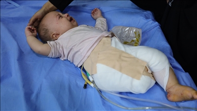 Anne kucağındayken İsrail bombardımanına yakalanan 4 Aylık bebek, yaşamına tek bacakla devam edecek