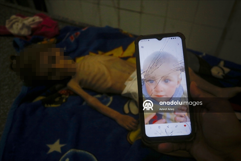 Gazze'de yetersiz beslenme nedeniyle bir bebek daha hayatını kaybetti