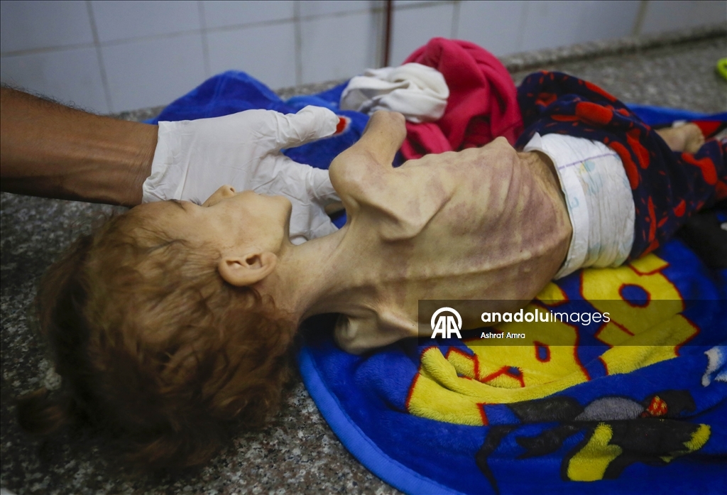 Gazze'de yetersiz beslenme nedeniyle bir bebek daha hayatını kaybetti