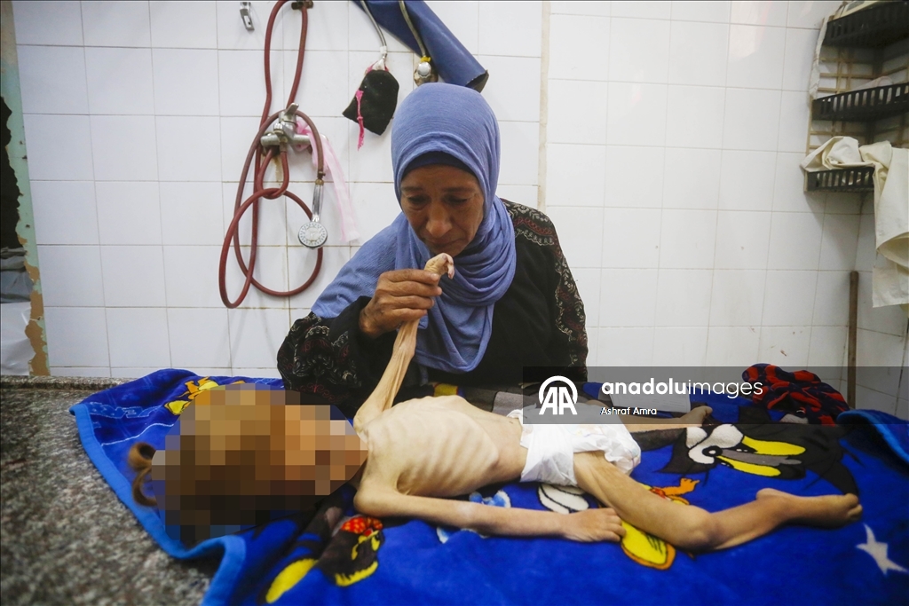 Gazze'de yetersiz beslenme nedeniyle bir bebek daha hayatını kaybetti