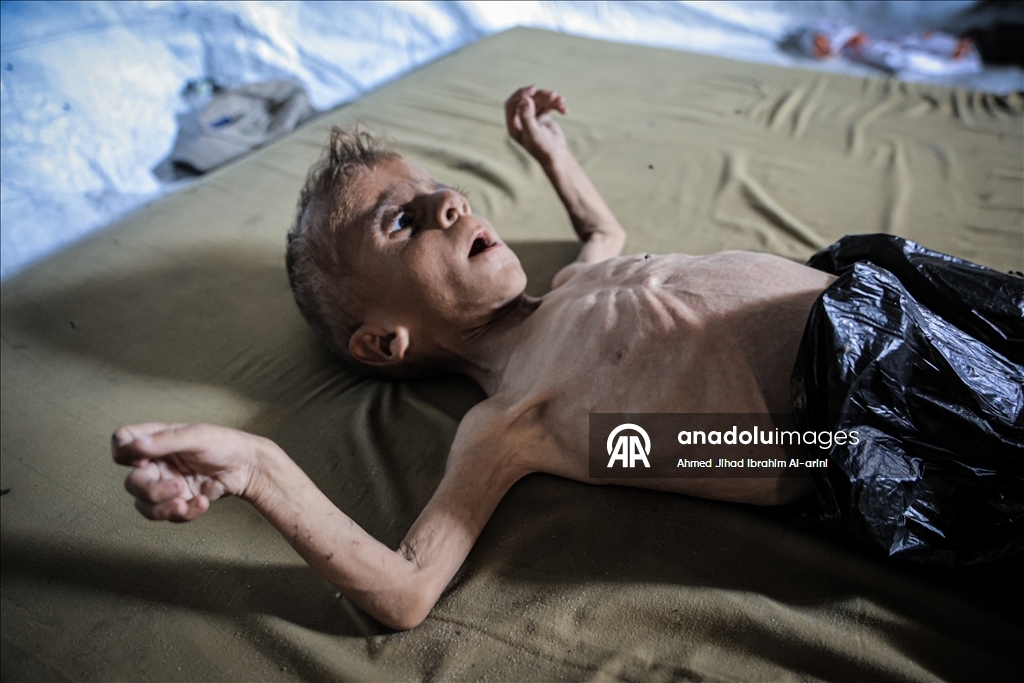 Malnourished toddler in Gaza fights for life amid ongoing Israeli attacks