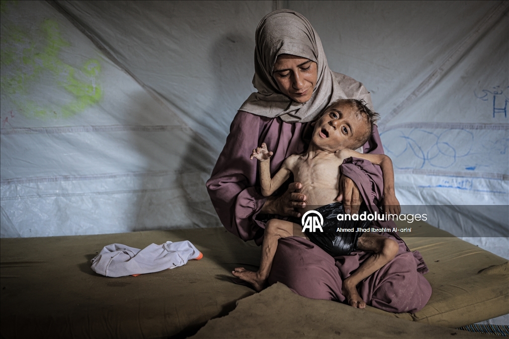 Malnourished toddler in Gaza fights for life amid ongoing Israeli attacks